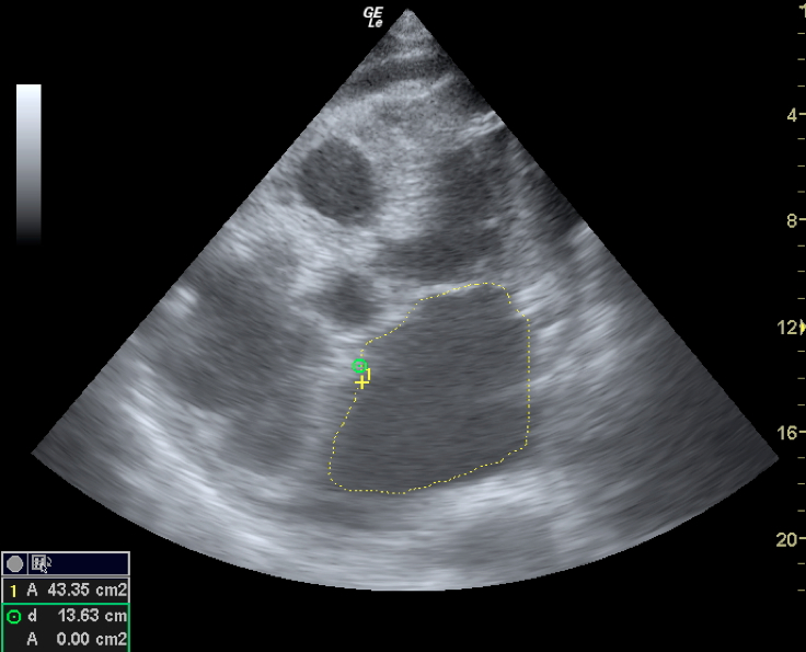 Plano apical cuatro cámaras Ecografía Clínica FESEMI