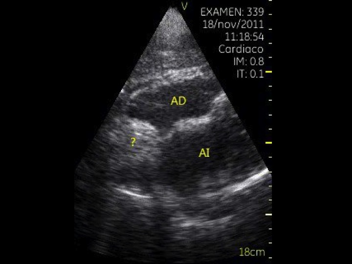 Hipertrofia Lipomatosa Del Septo Interauricular Ecograf A Cl Nica