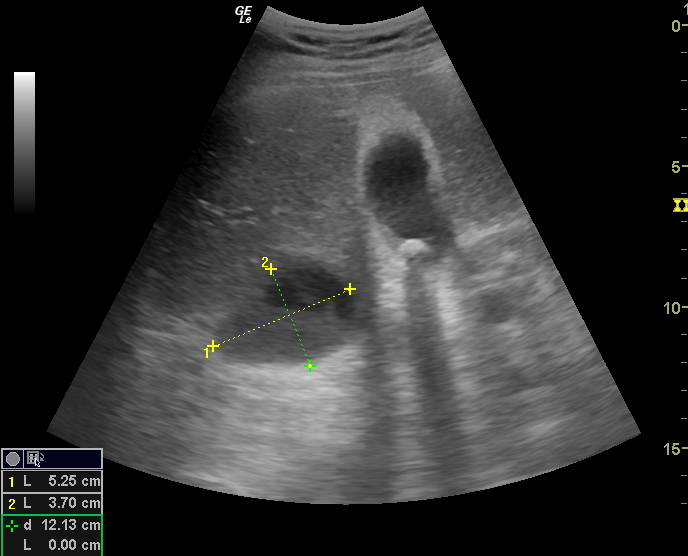 Dolor en hipocondrio derecho en varón de 59 años Ecografía Clínica